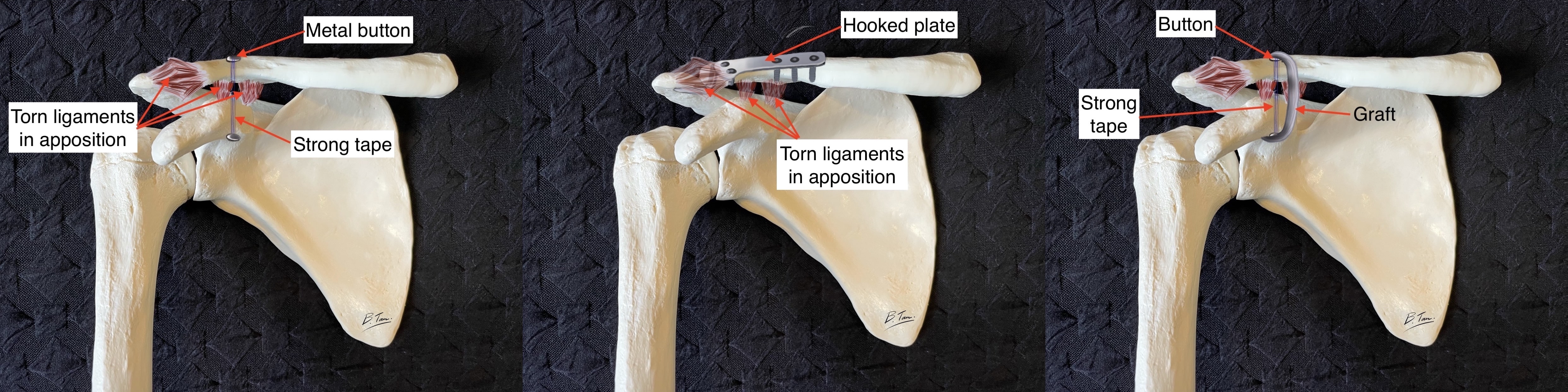 Acromioclavicular Joint Dislocation Specialist Dr Bryan Tan