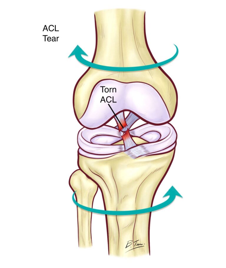Anterior Cruciate Ligament (ACL) Surgery Singapore | Dr Bryan Tan