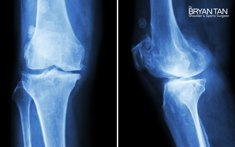 X-ray of osteoarthritis