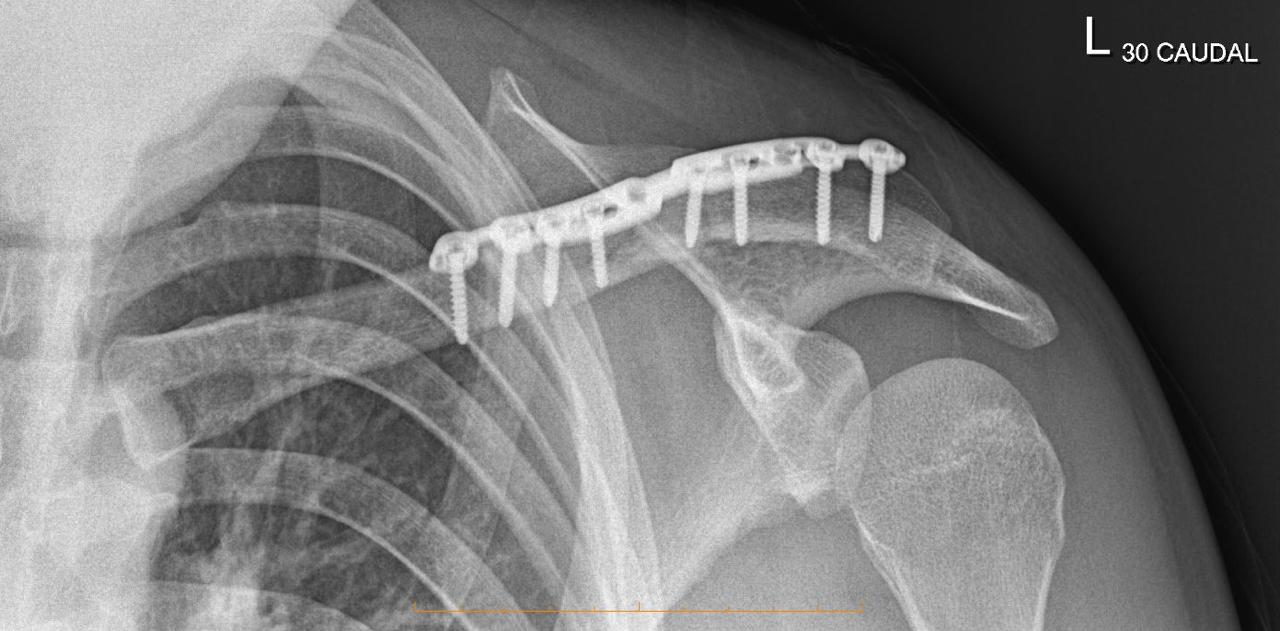 X-ray of a left shoulder showing clavicle, scapula, and humerus with surgical plate and screws attached.