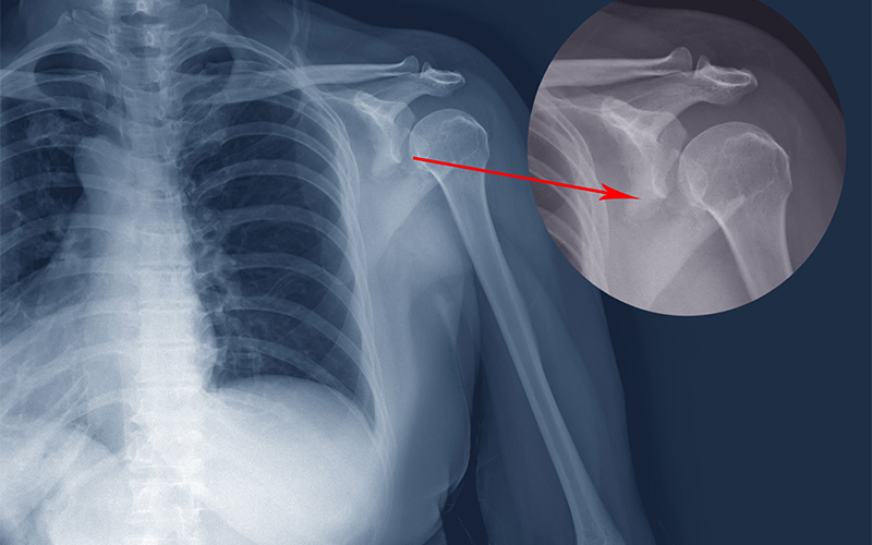 X-ray showing a clavicle fracture in an athlete.